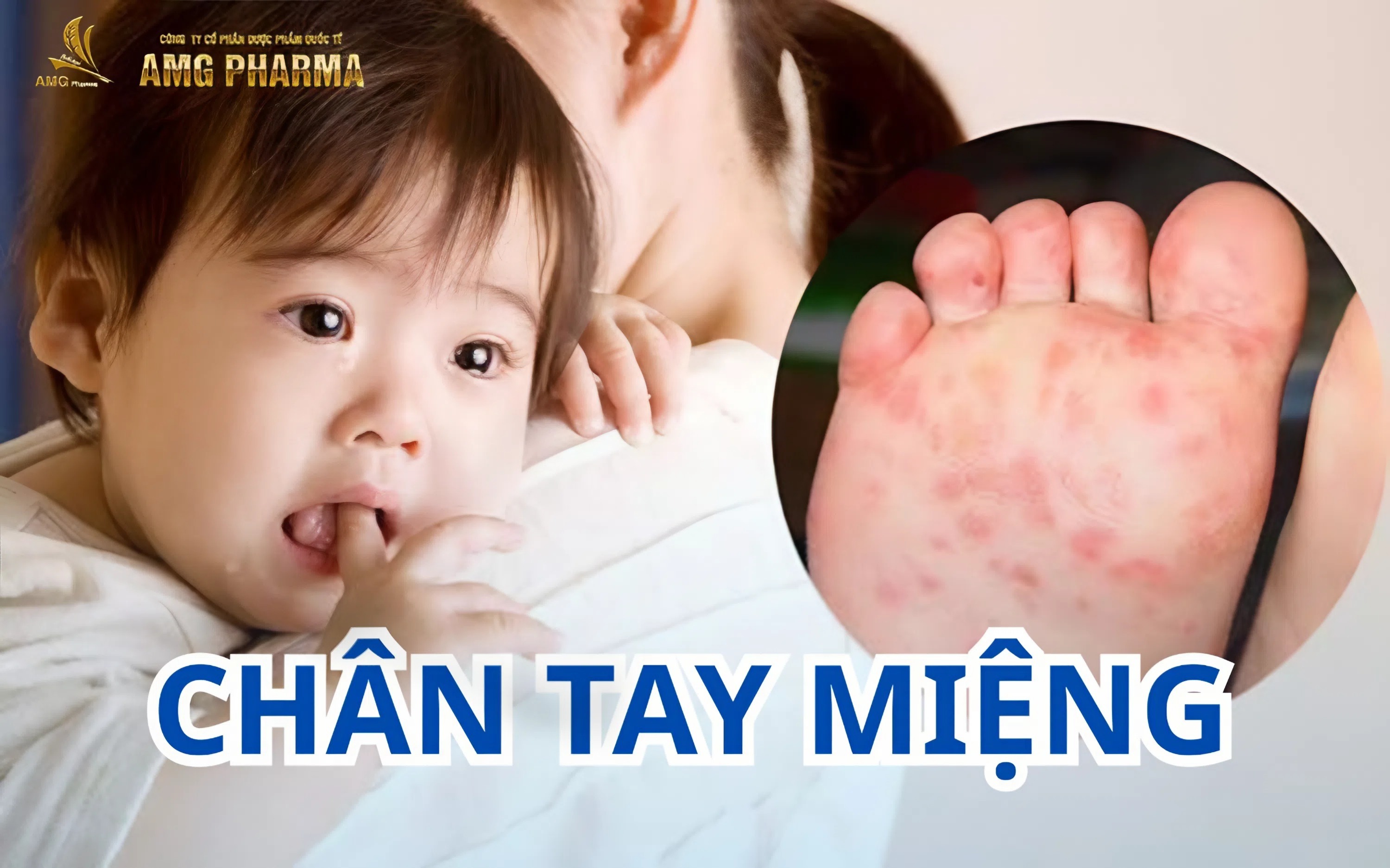 LÂY NHIỄM BỆNH CHÂN TAY MIỆNG Ở TRẺ NHỎ VÀO MÙA HÈ
